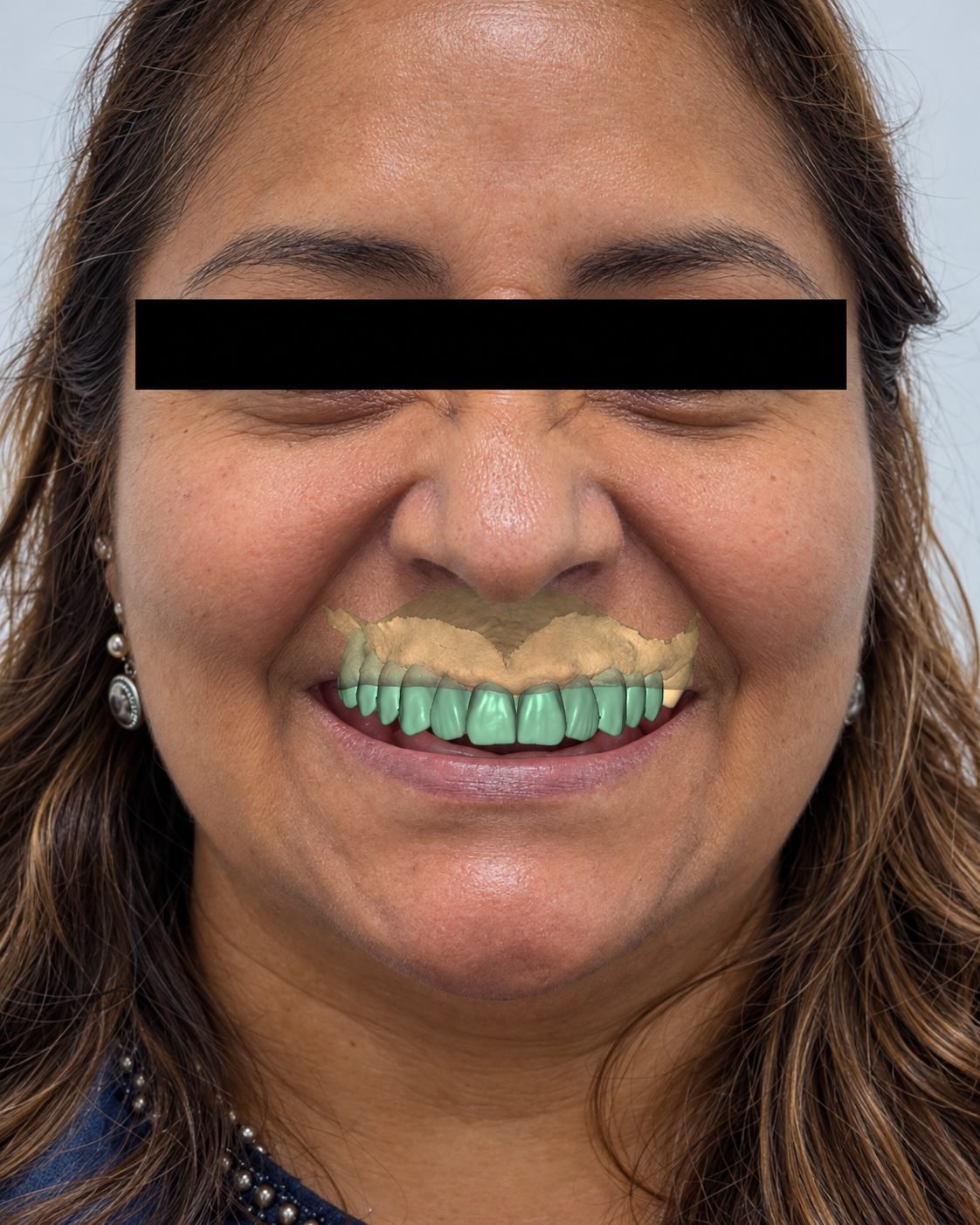Paciente antes del tratamiento con la planificación digital de su nueva sonrisa